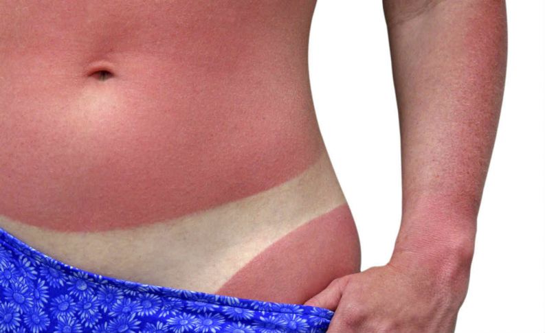 Doenças de verão: conheça as mais comuns e saiba como se prevenir